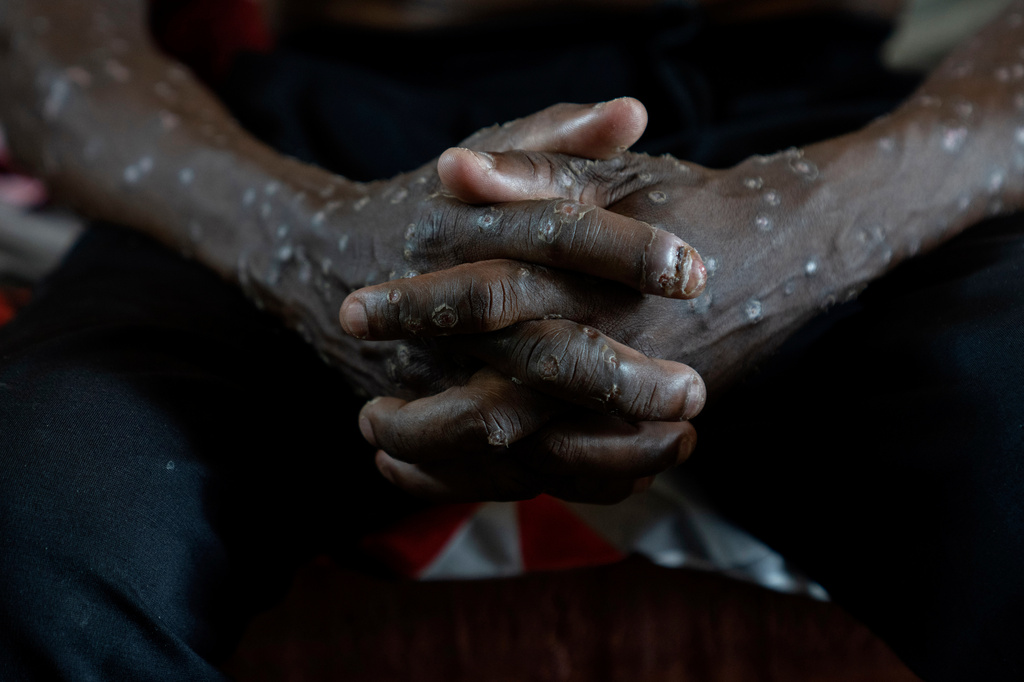 FILE - A man suffering from mpox waits for treatment at the Kamituga General Hospital in South Kivu Congo, Wednesday, Sept. 4, 2024. (AP Photo/Moses Sawasawa, File)