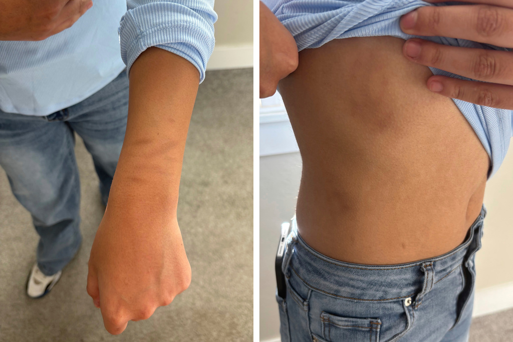 This combination of photos provided by Anabel Romero shows bruises on the wrist, left, and torso of her 14-year-old daughter in Meridian, Idaho, on Oct. 20, 2025, a day after she was detained by law enforcement agents during a raid on a horse race track. (Anabel Romero via AP)