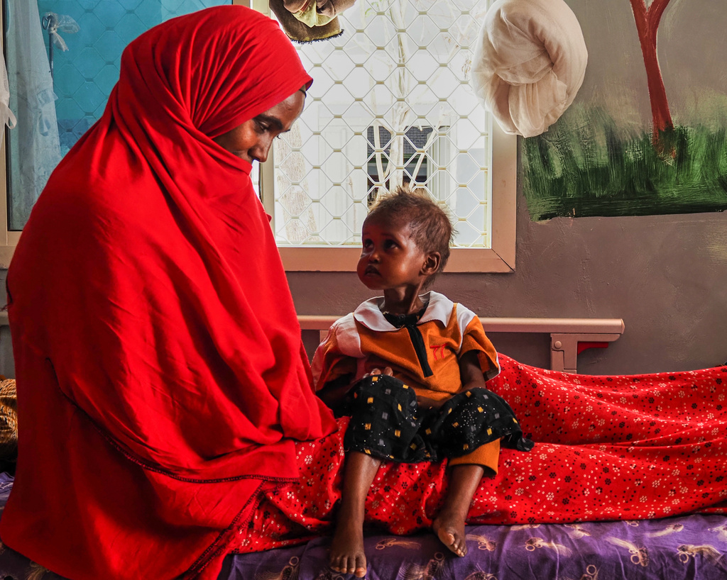 A mother looks at her daughter, who is suffering from severe acute malnutrition, at a stabilization center in a hospital in Qardho, Puntland, Somalia, Friday, April 17, 2026. (AP Photo/Jack Denton)