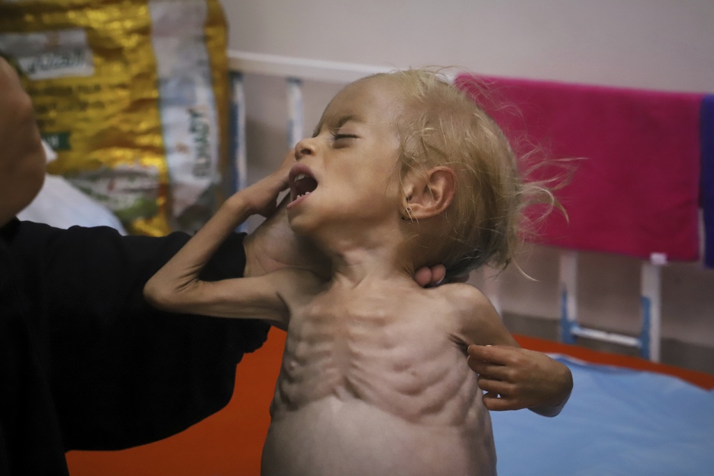 Islam Qudeih shows her severely malnourished shirtless, 2-year-old daughter, Shamm, to journalists at Nasser Hospital in Khan Younis, southern Gaza Strip, Saturday, Aug. 9, 2025. Doctors said Shamm may have a genetic disorder that affects muscle and bone development, but there is no way to test for it in Gaza. On Tuesday, August 12, her family was granted permission to travel to a hospital in Italy. (AP Photo/Mariam Dagga)
