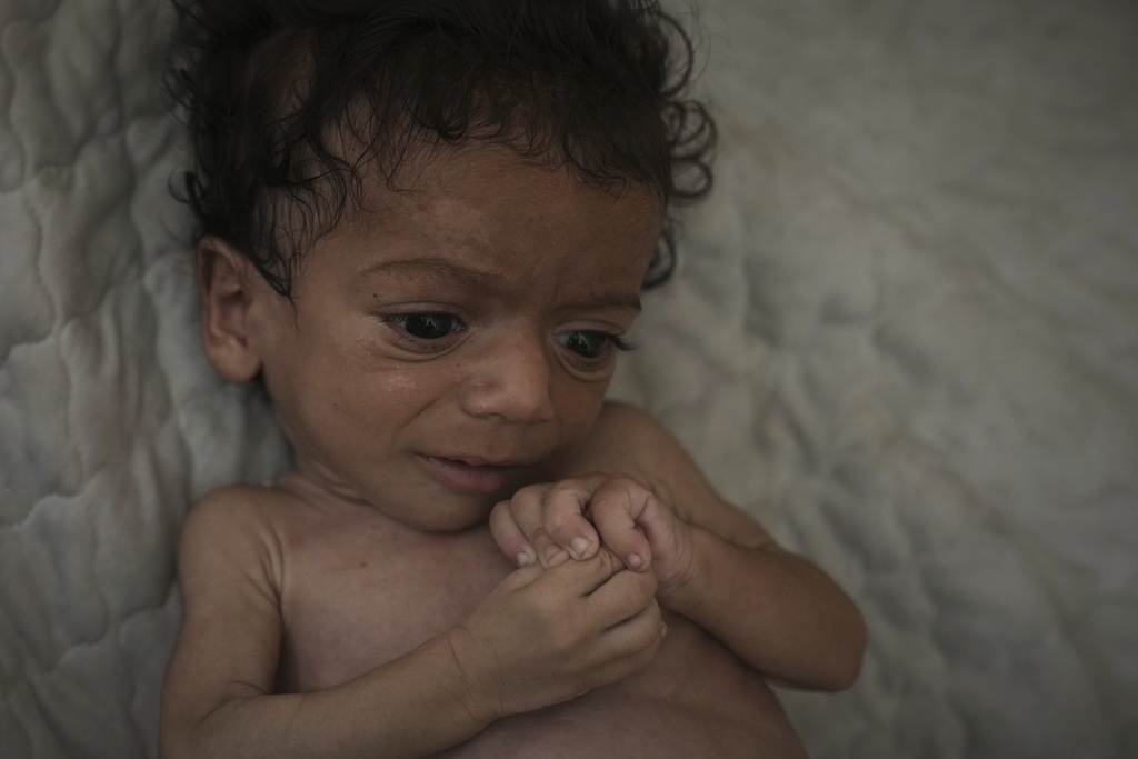 Seven-month-old Salem Awad, suffering from severe malnutrition, lies on a mattress in his family's tent in Gaza City, July 28, 2025. (AP Photo/Jehad Alshrafi)