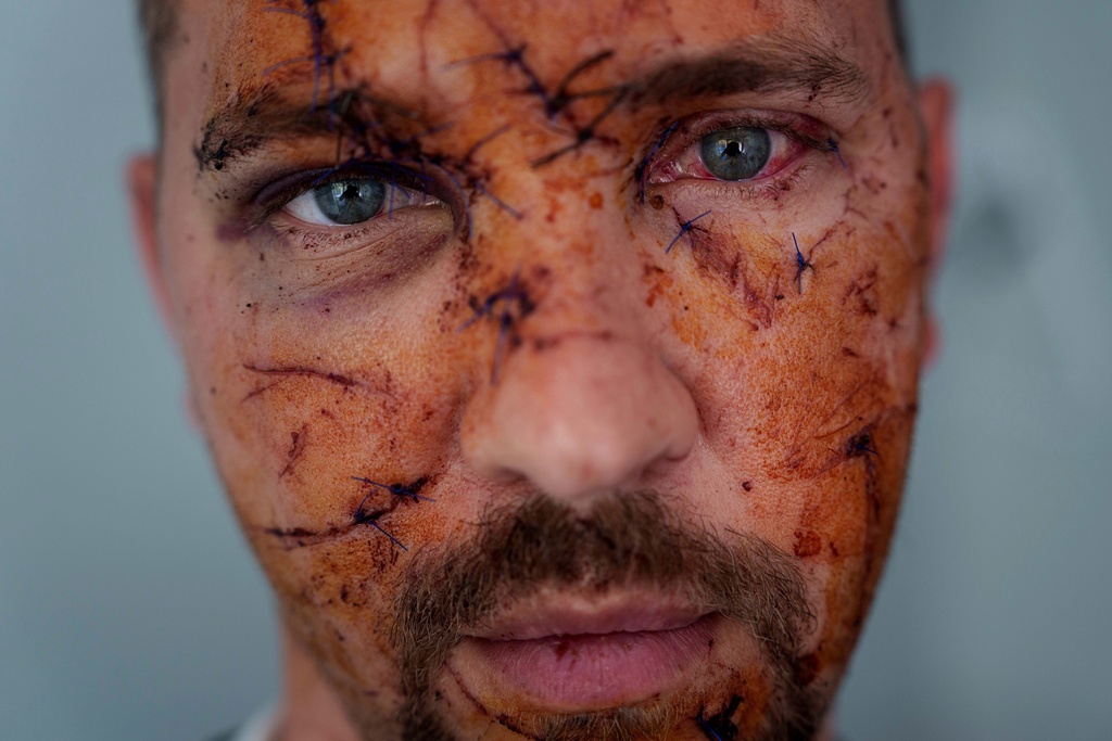 FILE - Multiple wounds can be seen on the face of Kostiantyn Bychek during a hospital visit in Kyiv, Ukraine, April 25, 2025. He was injured in a Russian strike. (AP Photo/Evgeniy Maloletka, File)