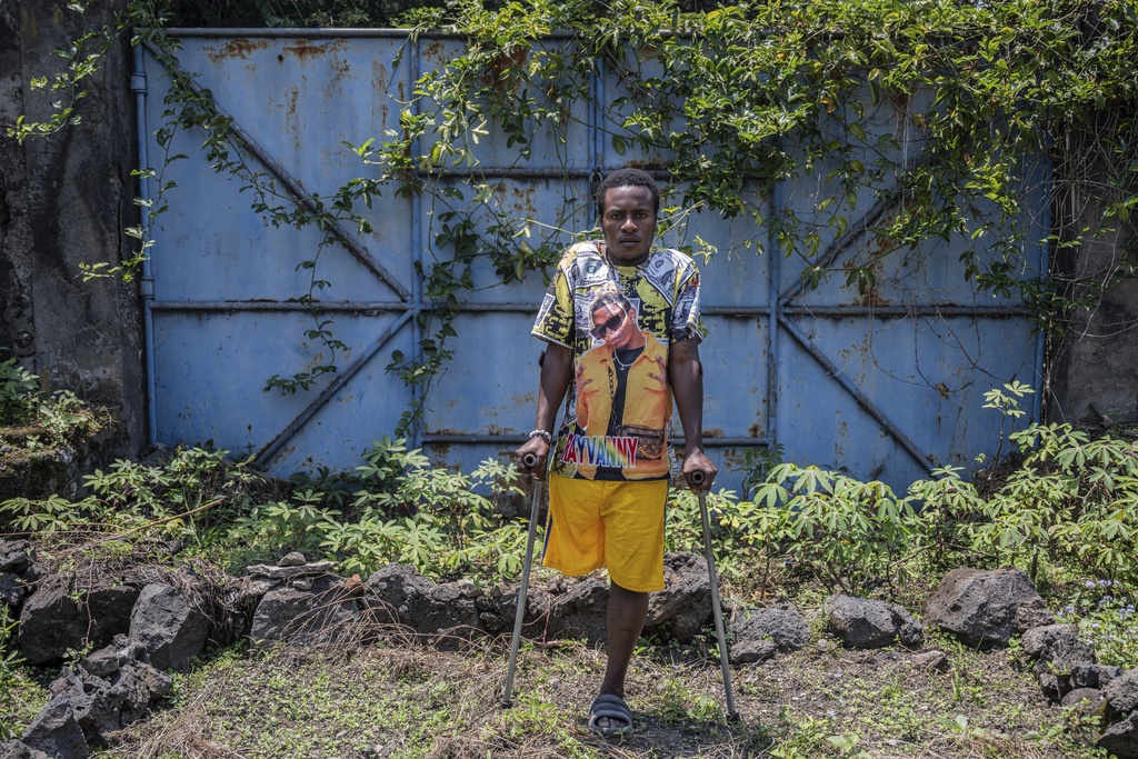 Patrick Mauka, one of many wounded by fighting in the region, poses for a photo at an orthopedic center run by the Catholic church and supported by Red Cross in Goma, eastern Congo, Friday, Aug. 29, 2025. (AP Photo/Moses Sawasawa)