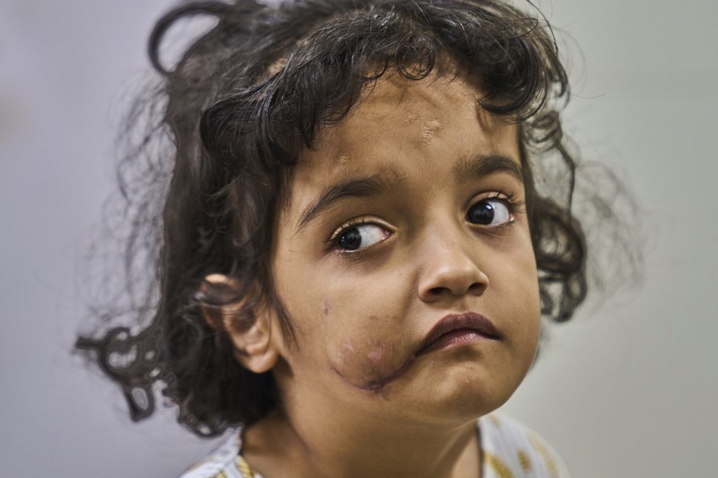 Rehmat Ashraf, 6, who was attacked by a stray dog outside her house, poses for a picture inside the anti-rabies clinic at a hospital in Srinagar, Indian controlled Kashmir, Thursday, Sept. 18, 2025. (AP Photo/Dar Yasin)