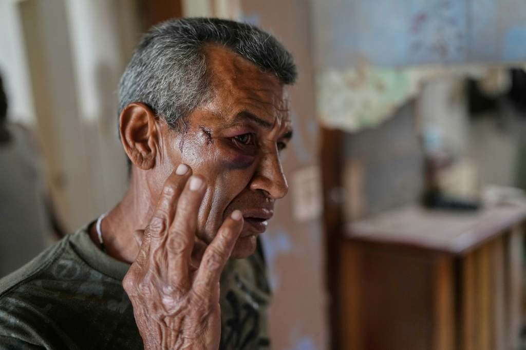 Wilman Gonzalez shows an injury he says he suffered when his home was hit during U.S. military operations to capture Venezuelan President Nicolas Maduro, in Catia La Mar, Venezuela, Sunday, Jan. 4, 2026. (AP Photo/Matias Delacroix)