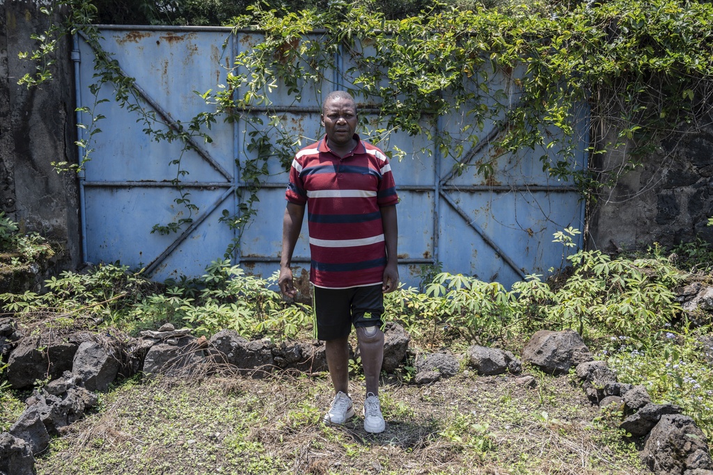 Jerome Jean-Claude Amani, one of many wounded by fighting in the region, poses for a photo at an orthopedic center run by the Catholic church and supported by Red Cross in Goma, eastern Congo, Friday, Aug. 29, 2025. (AP Photo/Moses Sawasawa)