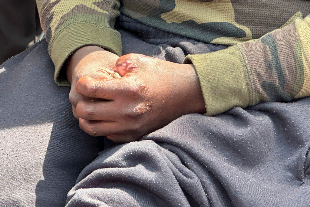 Rashaad Muhammad rests his hands with amputated fingers in his lap during a news conference outside the Fulton County Jail, in Atlanta, Wednesday, April 29, 2026. (AP Photo/Kate Brumback)