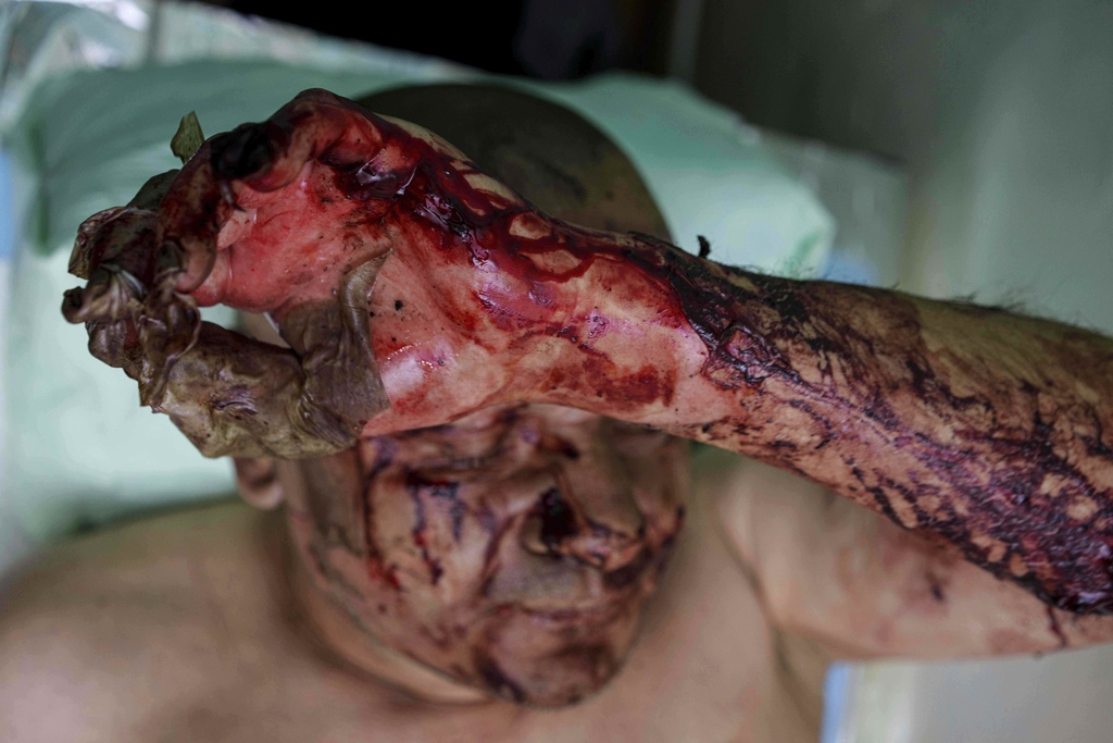 EDS NOTE: GRAPHIC CONTENT - Burns on the face and hand of a Ukrainian soldier who was injured during fighting with Russian forces on the front line, at stabilization point of Da Vinci Wolves Battalion on Pokrovsk direction, Ukraine, on Monday, Aug. 11, 2025. (AP Photo/Evgeniy Maloletka)