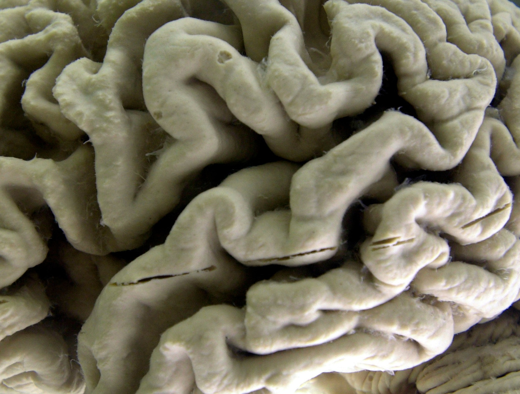 FILE - A human brain affected by Alzheimer's disease is displayed at the Museum of Neuroanatomy at the University at Buffalo in Buffalo, N.Y., on Oct. 7, 2003. (AP Photo/David Duprey, File)