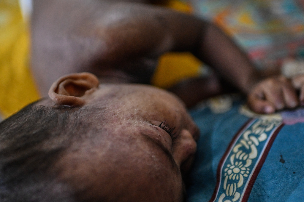 A child rests as he receives treatment during a measles outbreak in a hospital in Dhaka, Bangladesh, Tuesday, Sept. 8, 2026. (AP Photo/Mahmud Hossain Opu)