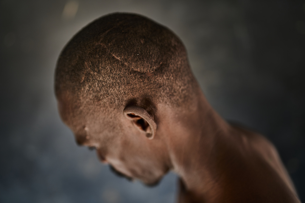Hussein Mohamed Shareef shows the scar on his head where he said an RSF sniper shot him in Omdurman, as he poses for a photo at the Al Heshan camp for internally displaced people in Port Sudan, Sudan, Wednesday, April 15, 2026. (AP Photo/Bernat Armangue)