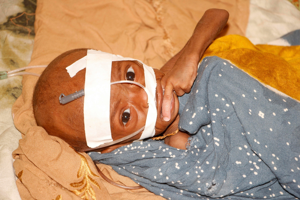 FILE - A malnourished child receives treatment at Banadir Hospital in Mogadishu, Somalia, May 14, 2025. (AP Photo/Farah Abdi Warsameh, File)