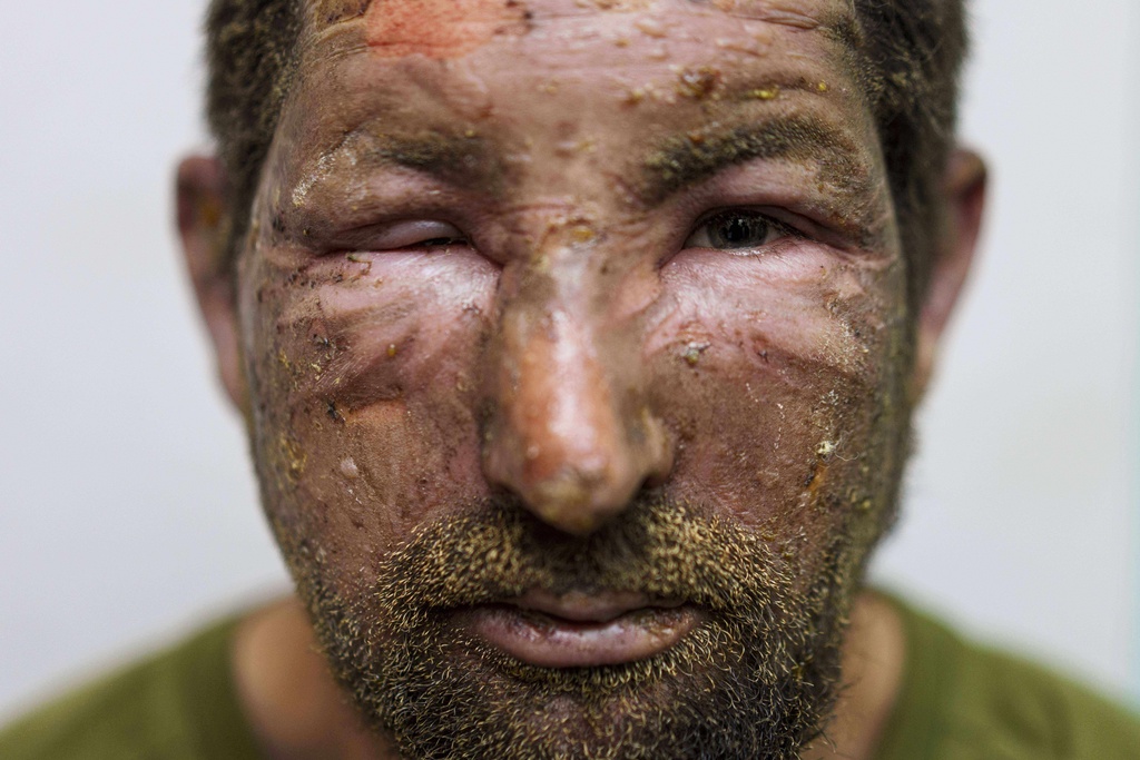Burns mark the face of Artem, aka "Lisnyk," a Ukrainian soldier of the Da Vinci Wolves Battalion, injured during fighting with Russian forces on the front line in the Pokrovsk direction, Ukraine, Aug. 10, 2025. (AP Photo/Evgeniy Maloletka)