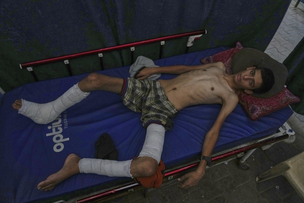 FILE - Ahmad Sbeteh, 17, injured by shrapnel from a strike on a neighboring house, has lost about 15 kilograms (33 pounds), and doctors say the lack of healthy food and nutritional supplements is slowing his recovery at Shifa Hospital in Gaza City on Monday, Aug. 18, 2025. Before the shrapnel injury, he had no preexisting conditions, doctors say. (AP Photo/Abdel Kareem Hana, File)