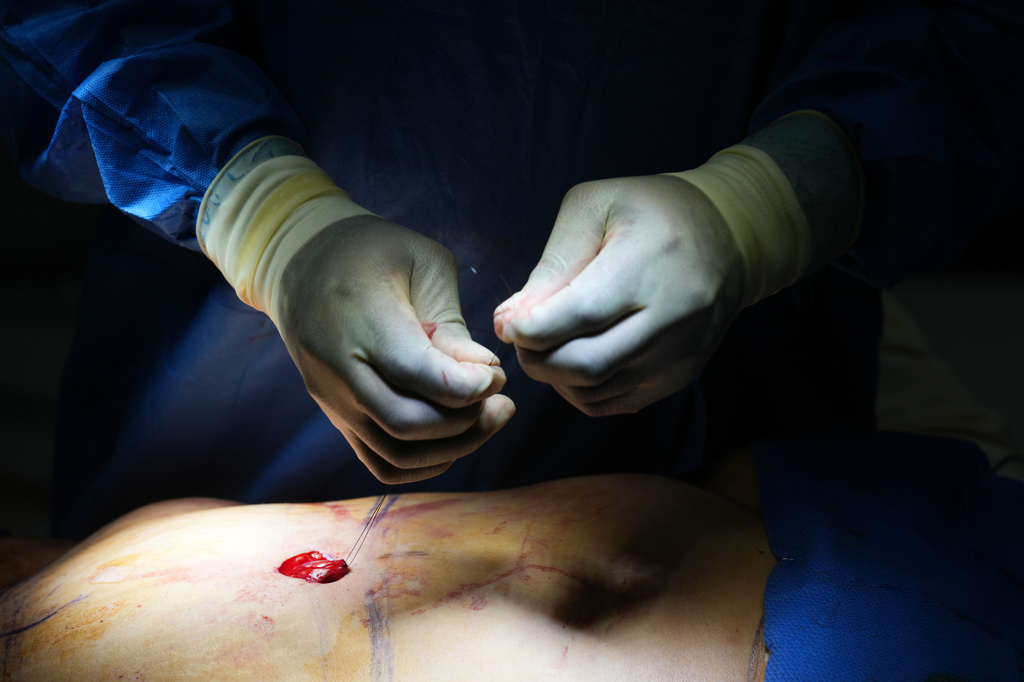 Plastic surgeon Dr. Michael Obeng performs a belly bottom reconstruction plastic surgery after a tummy tuck at a surgical center in Beverly Hills, Calif., on Thursday, Feb. 5, 2026. (AP Photo/Damian Dovarganes)