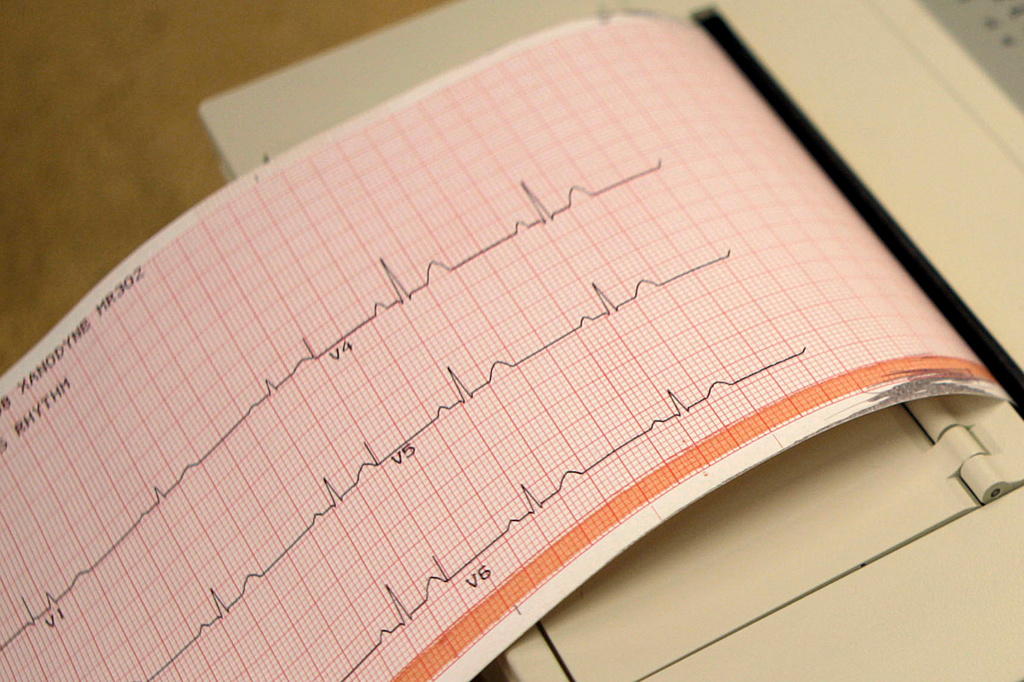FILE - A printout from an electrocardiogram machine in is seen, May 26, 2009, in Missouri. (AP Photo/Jeff Roberson, File)