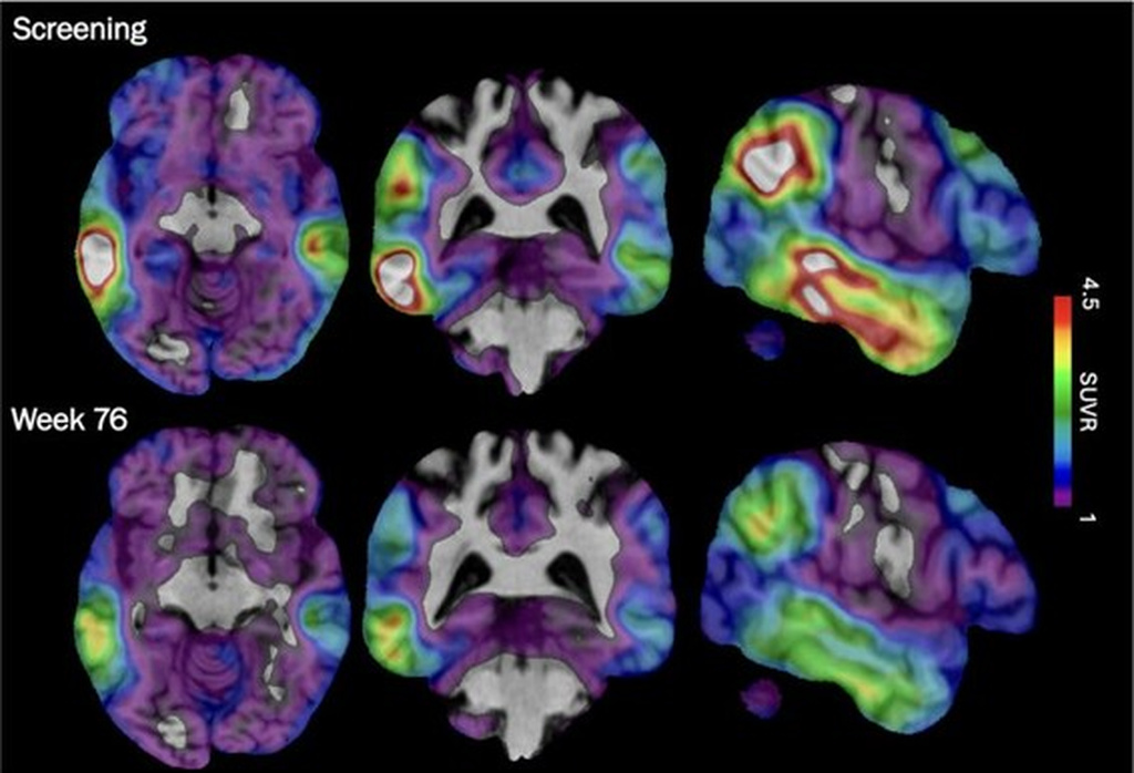 These brain scan images provided by Biogen show how high levels of Alzheimer's-related tau protein, in red, dropped in a recipient of the company's experimental drug diranersen. (Biogen via AP)