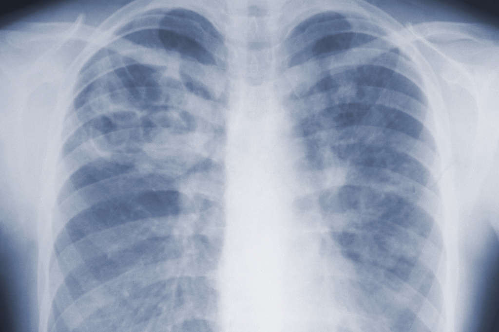 This 1967 chest x-ray photo provided by the U.S. Centers for Disease Control and Prevention shows pulmonary aspergillosis caused by a fungal organism of the genus Aspergillus. (CDC via AP)