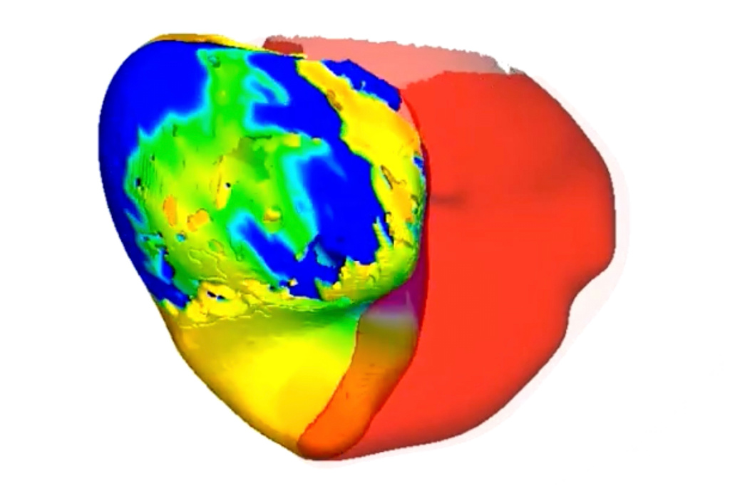 This image from video provided by Johns Hopkins University in March 2026 shows a digital twin of a heart belonging to a patient with an irregular heartbeat being used to simulate treatment approaches. (Johns Hopkins University via AP)
