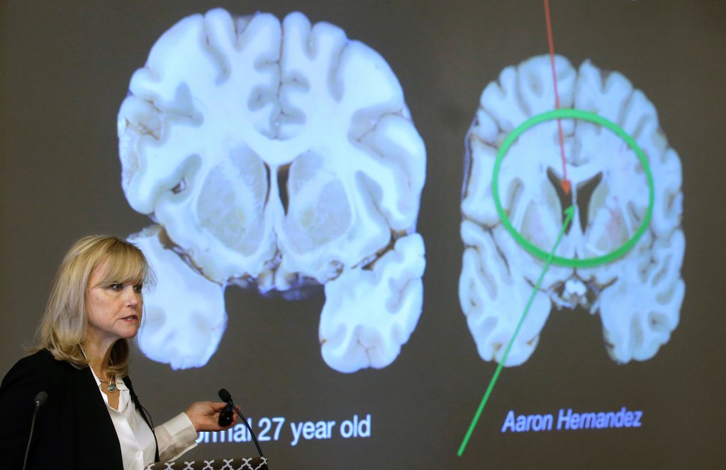 FILE - Ann McKee, director Boston University's center for research into the degenerative brain disease chronic traumatic encephalopathy, or CTE, addresses an audience on the school's campus Nov. 9, 2017 about the study of NFL football player Aaron Hernandez's brain, projected on a screen, behind right, in Boston. (AP Photo/Steven Senne, File)